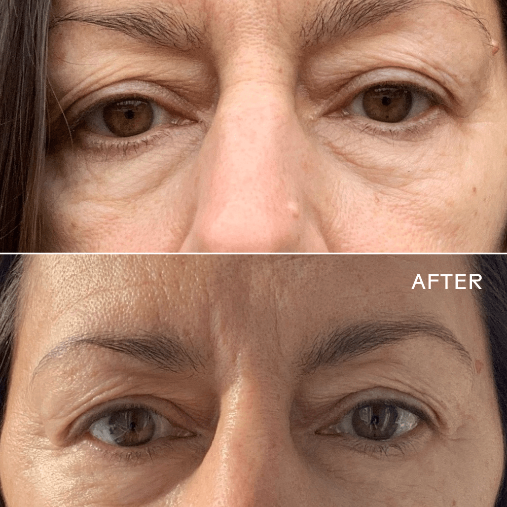 Before and after results showcasing the effectiveness of First Light Vitamin C + Caffeine Eye Cream on reducing dark circles.