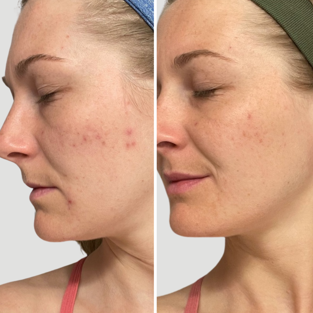 Before and after results of skin using Refresh Papaya + Salicylic Acid Cleanser, showing clearer skin.