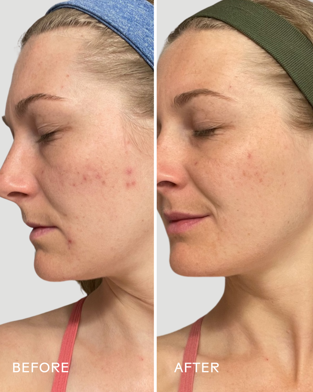 Before and after results of skin using Refresh Papaya + Salicylic Acid Cleanser, showing clearer skin.